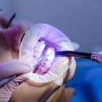 aliviar el dolor de los brackets recién puestos