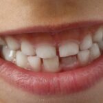 cada cuánto tiempo debo hacerme una limpieza dental