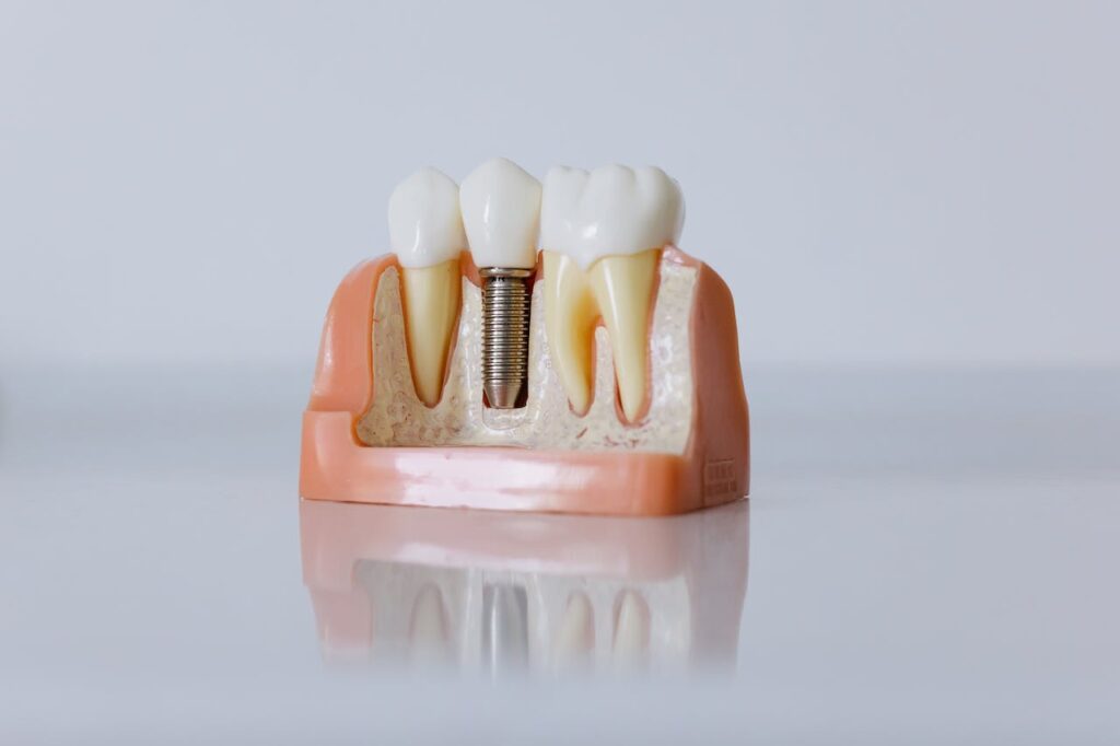 implantes dentales rapidos