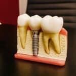 postoperatorio tras un implante dental