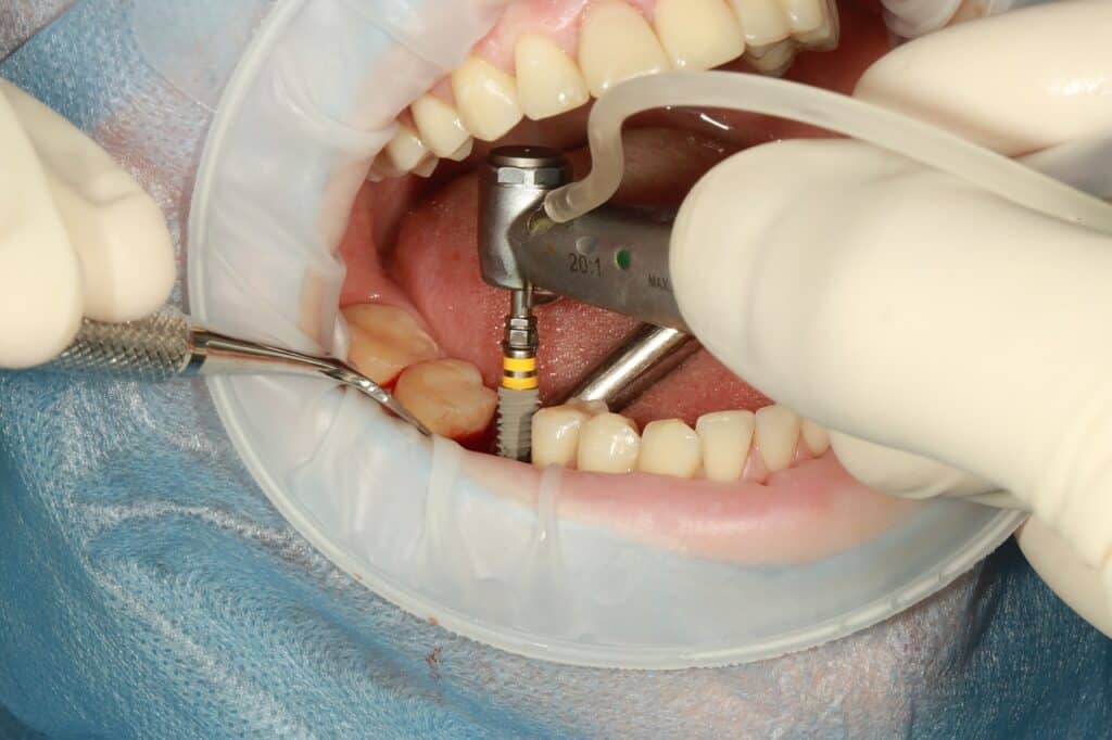rechazo de implante dental