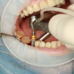 rechazo de implante dental