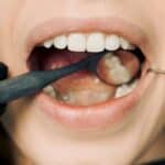 absceso dental