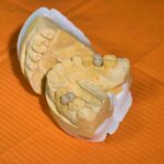 implante dental unitario