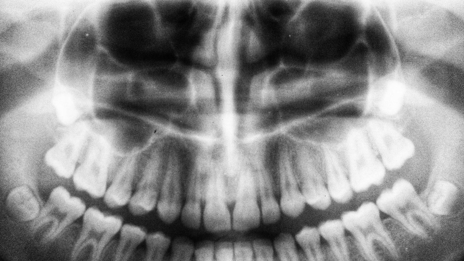 Implantes‍ dentales: Un análisis detallado de los riesgos y precauciones