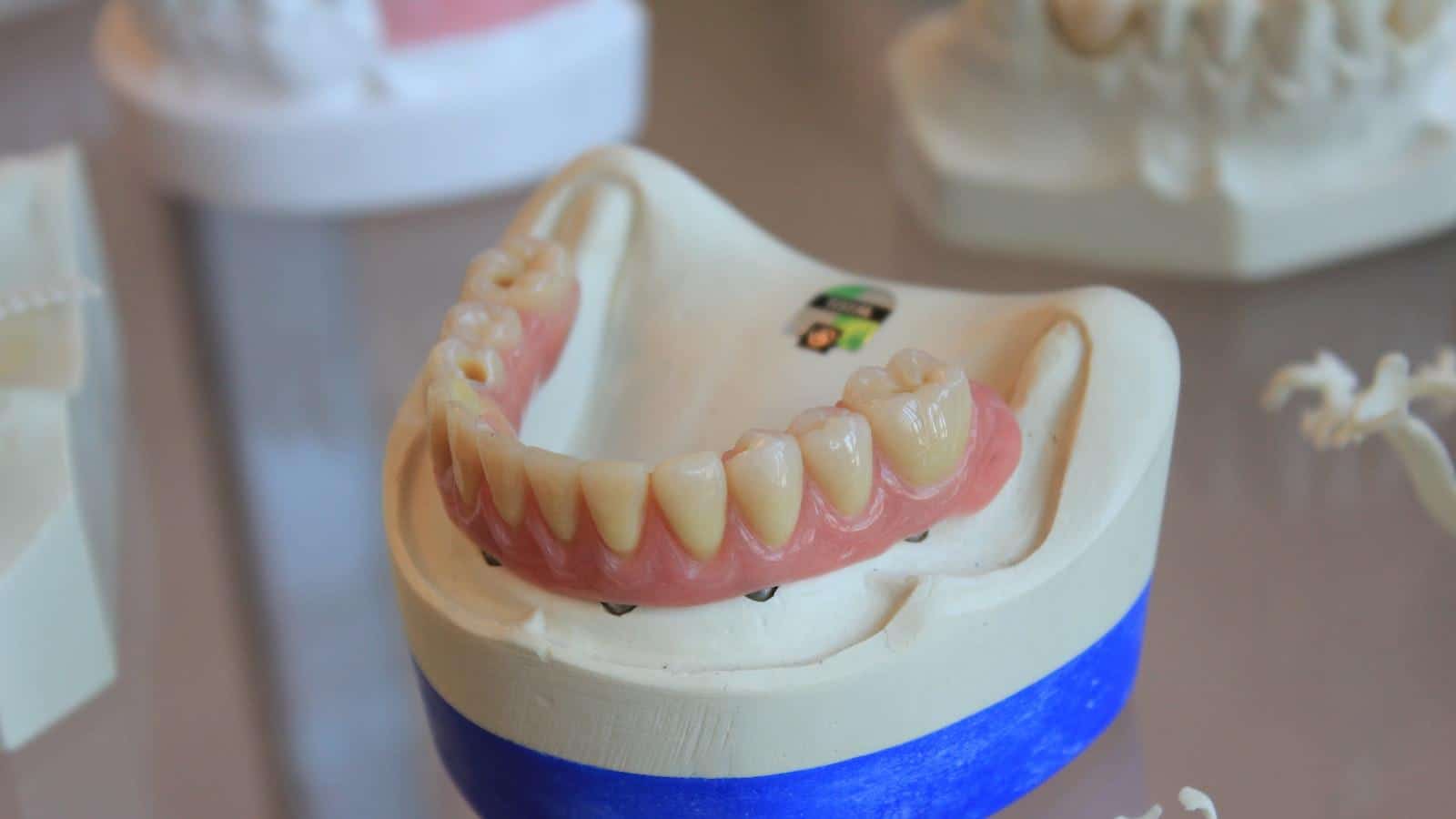 Recomendaciones para evitar riesgos con los implantes dentales