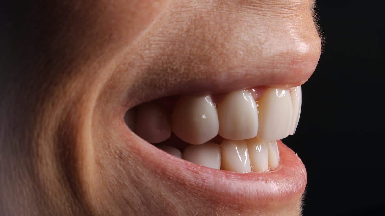 Posibles efectos‍ secundarios ⁣del ⁣blanqueamiento dental