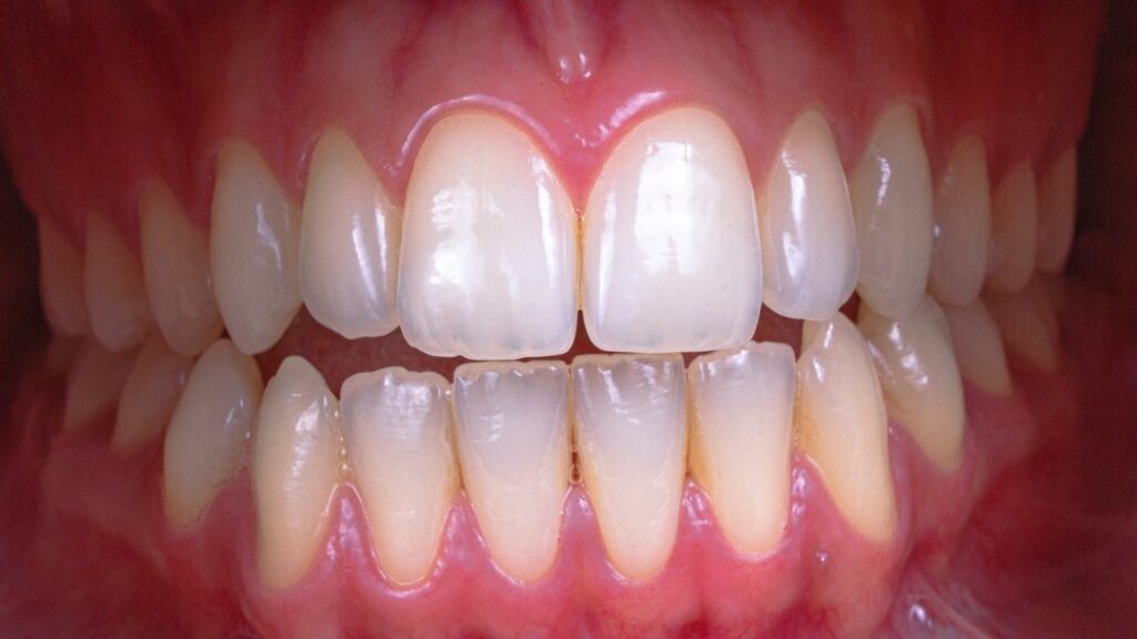 efectos secundarios del blanqueamiento dental