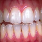 efectos secundarios del blanqueamiento dental