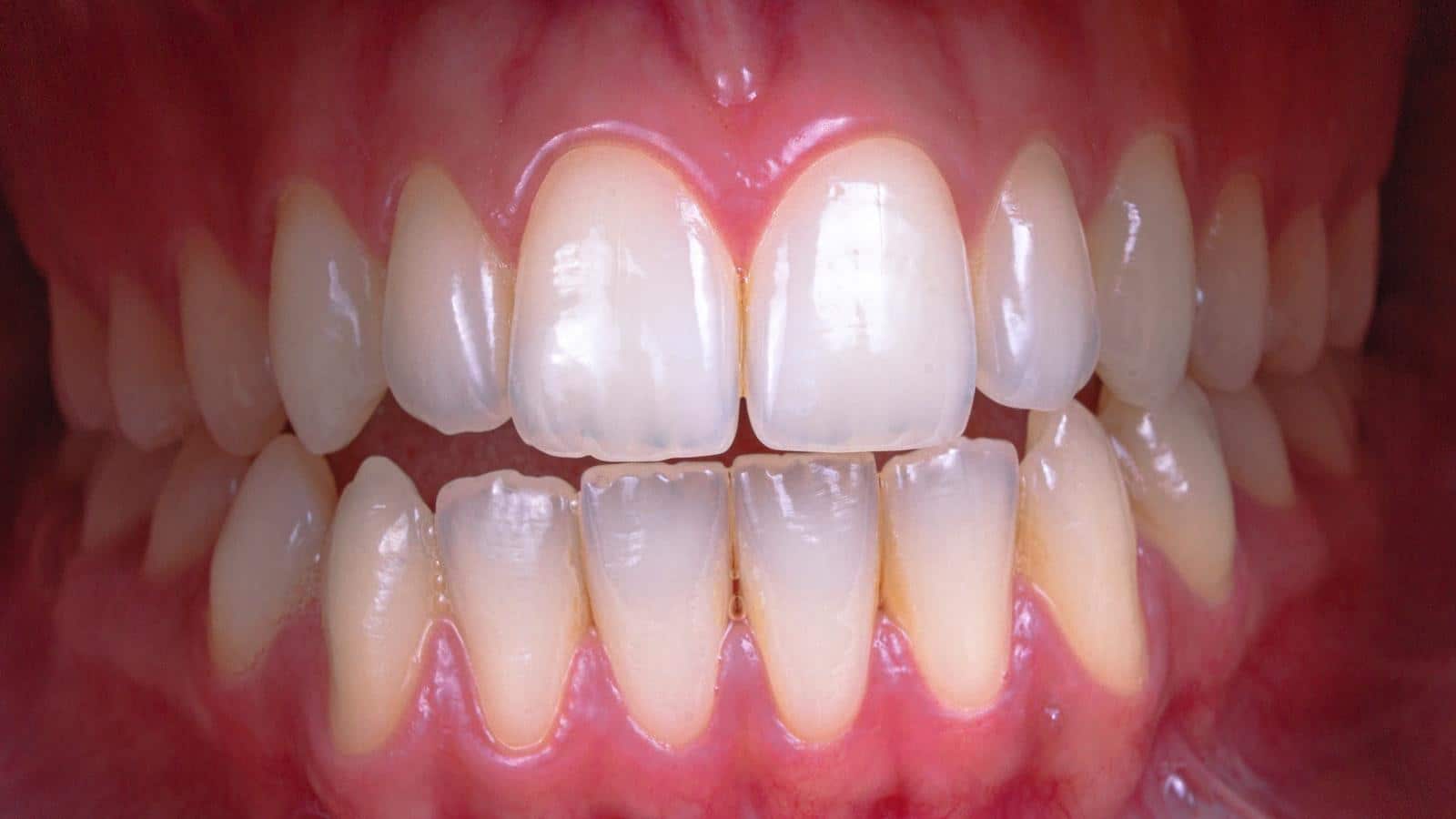 Recomendaciones para minimizar los efectos secundarios del blanqueamiento ⁤dental