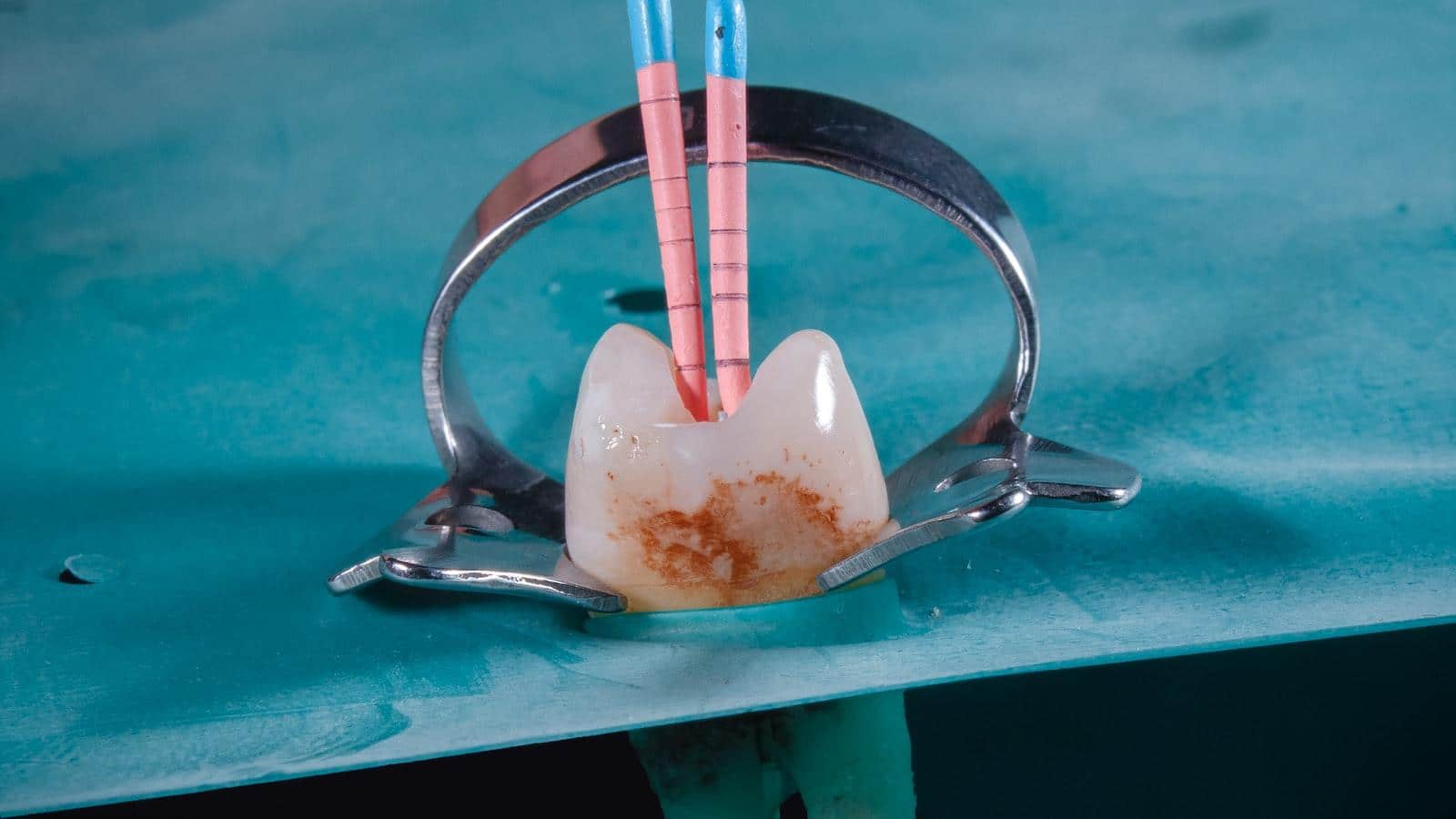 Prevención y cuidado posterior⁣ al blanqueamiento⁤ dental