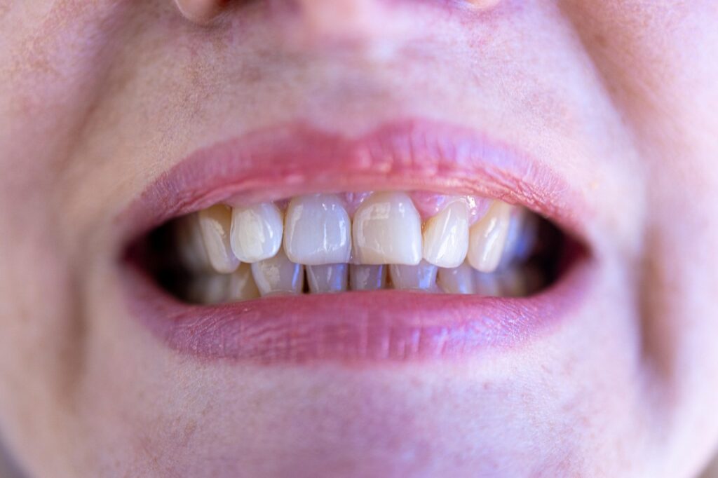 Blanqueamiento dental Casco