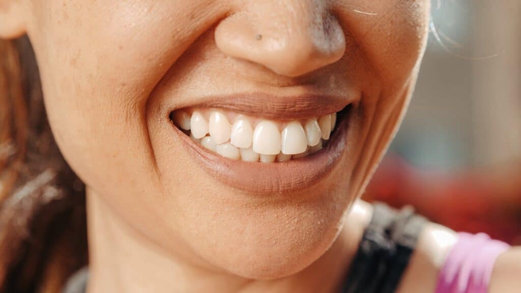 Blanqueamiento dental La Paz