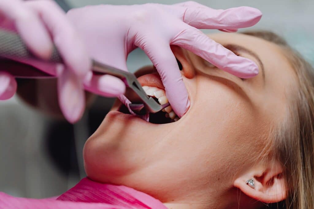 Extracciones dentales Torrero