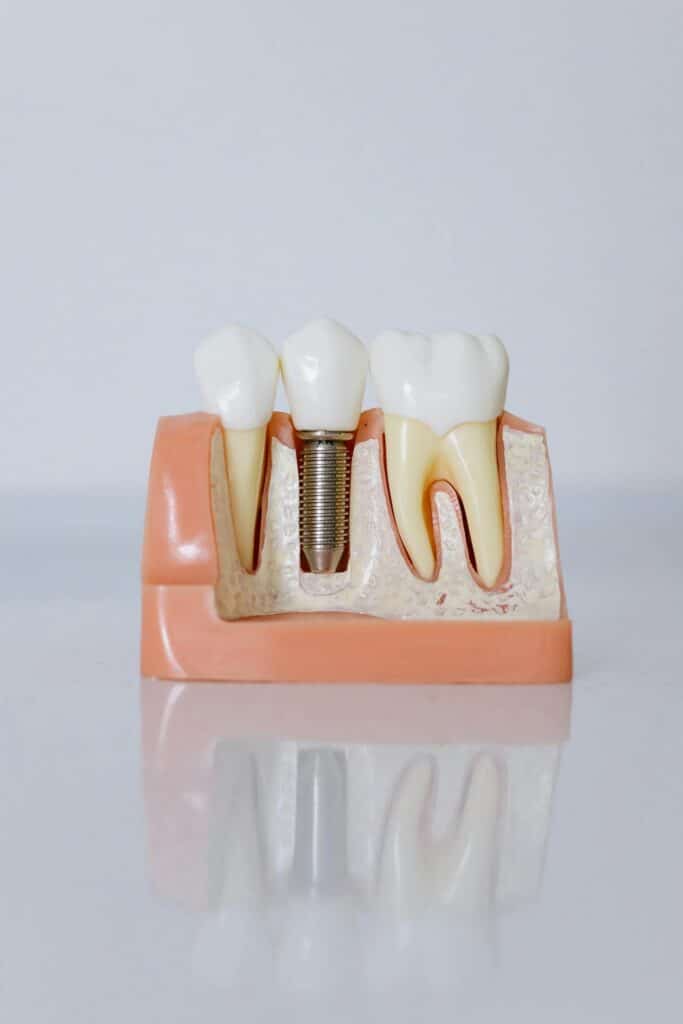 Implantes dentales Juslibol