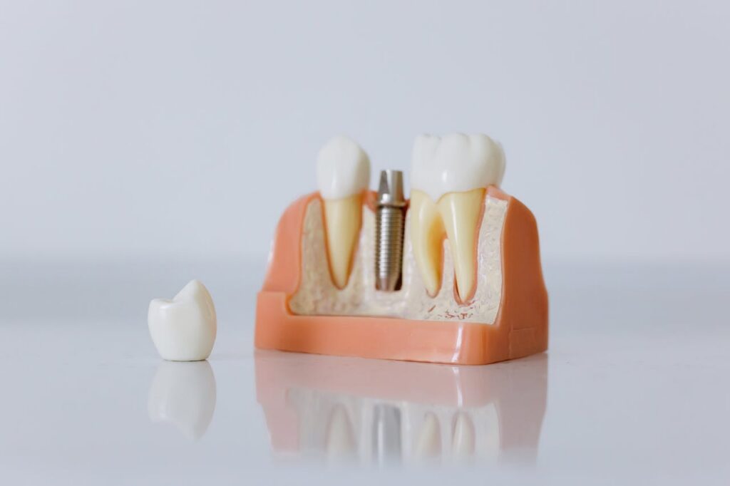 Implantes dentales La Paz